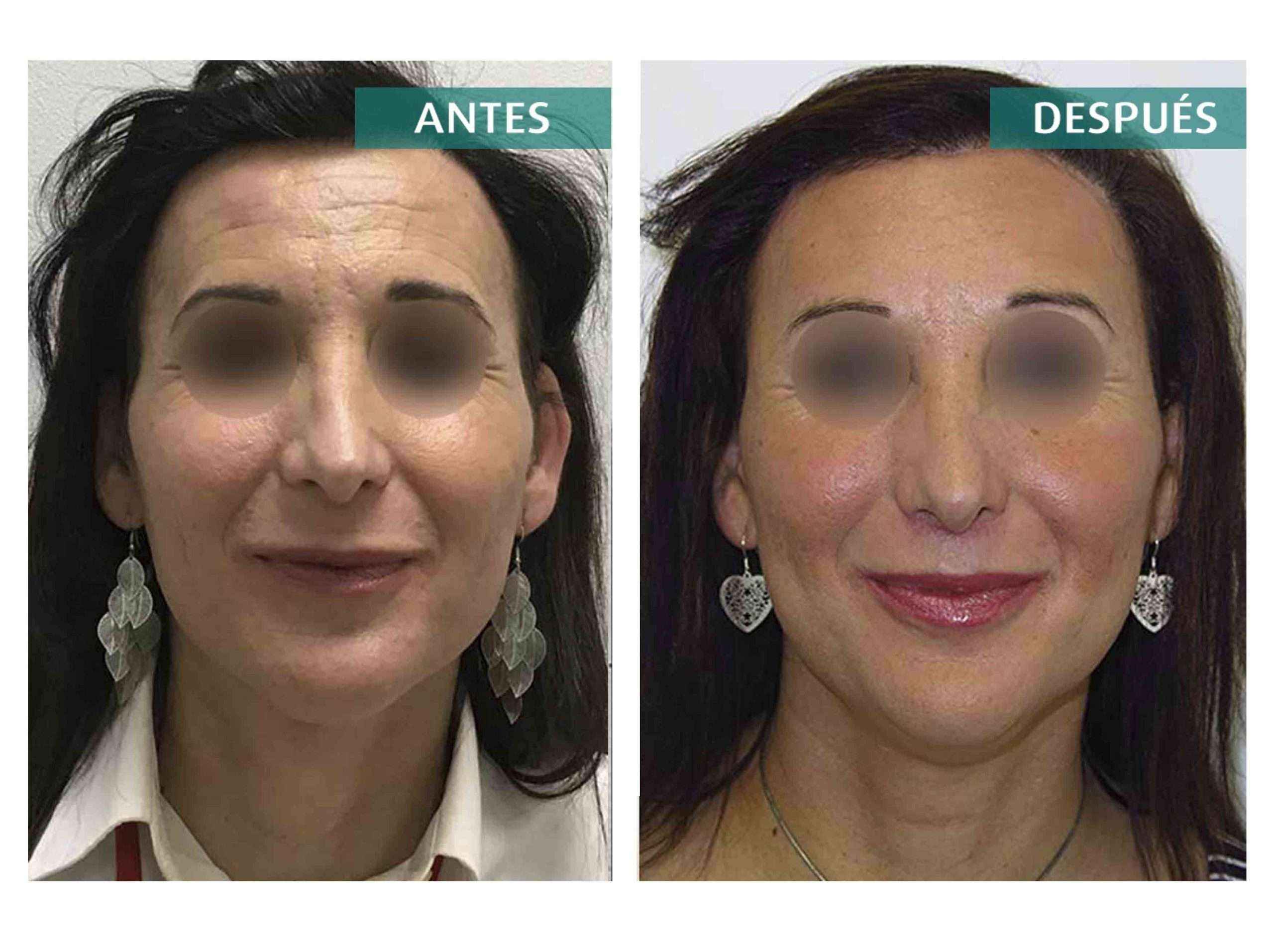 La feminización facial ayuda a las mujeres trans a reafirmar su identidad de género, según una revisión de estudios