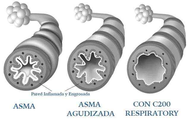Una empresa española presenta una innovación para el tratamiento de ahogo e inflamación de los pulmones