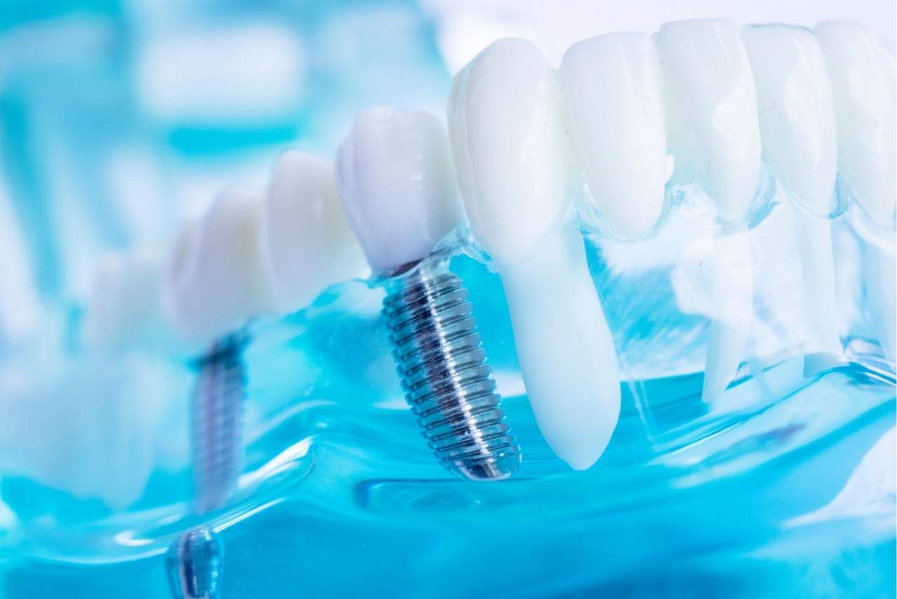 Implante Dentix en Sevilla