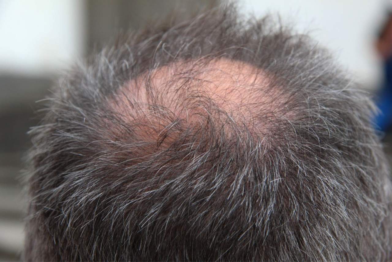 Consejos de Natura Estilo sobre cómo prevenir alopecia androgenética