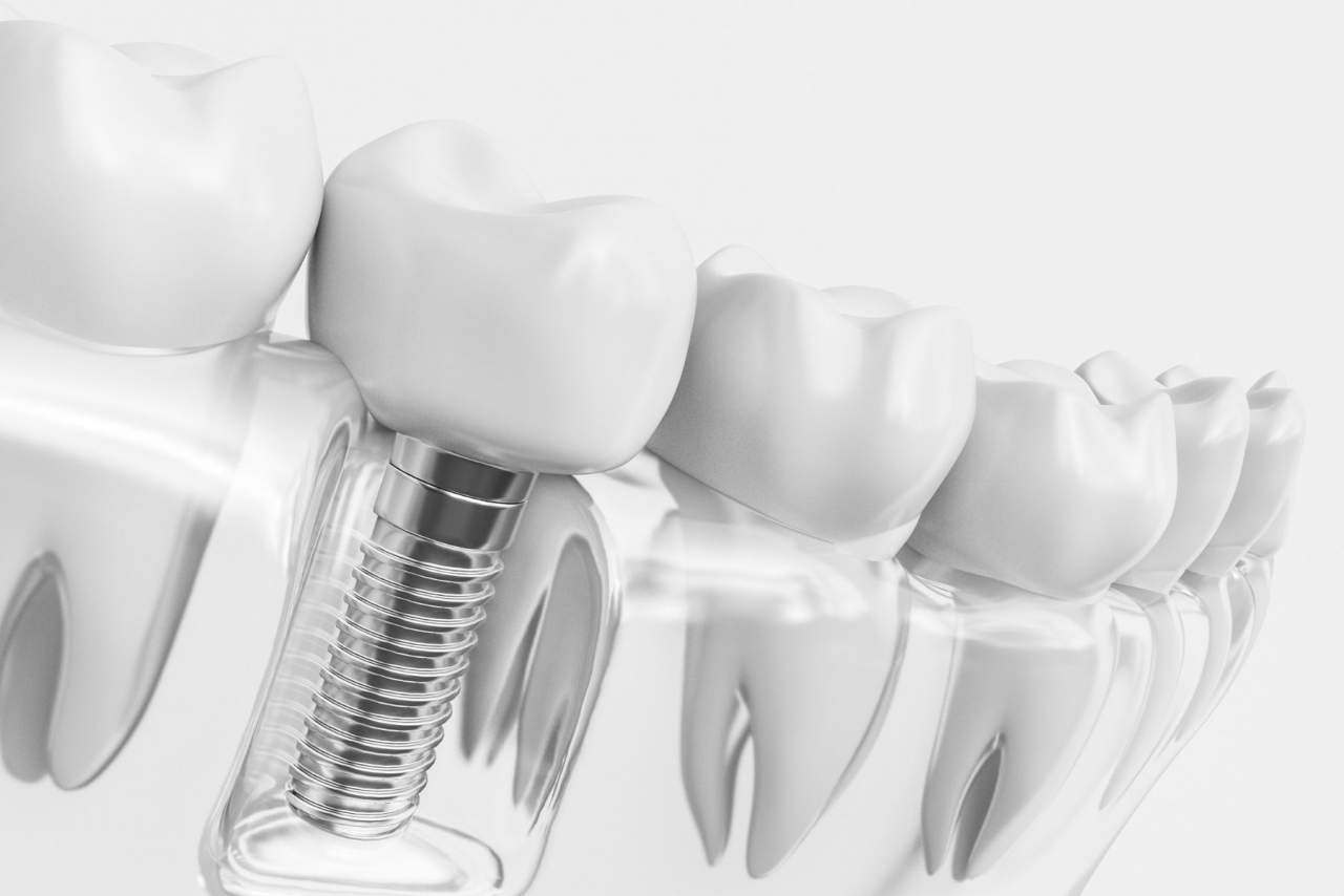 Implante dental profesional en Sevilla con Helident