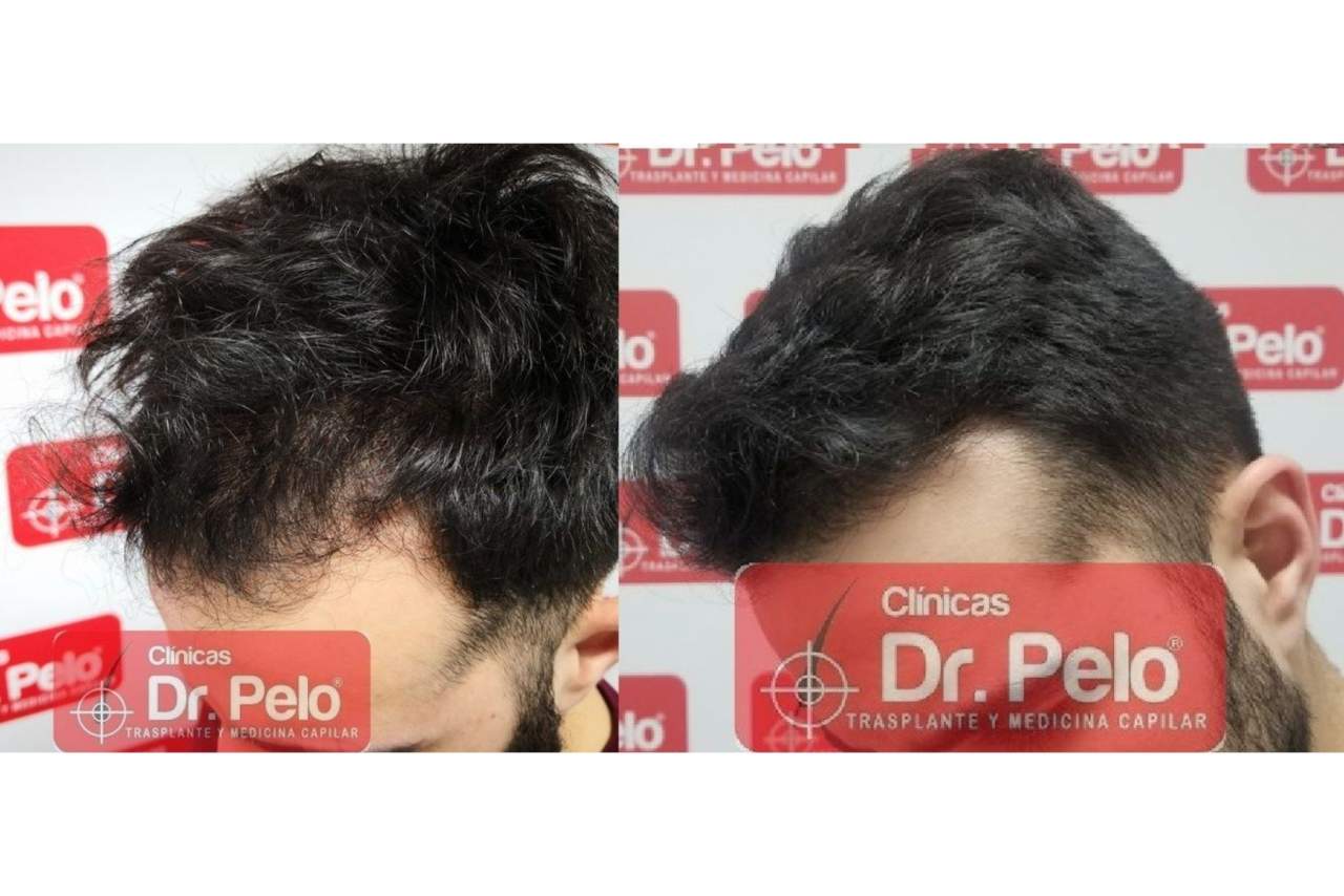 Clínicas Dr. Pelo: Trasplante capilar en Madrid
