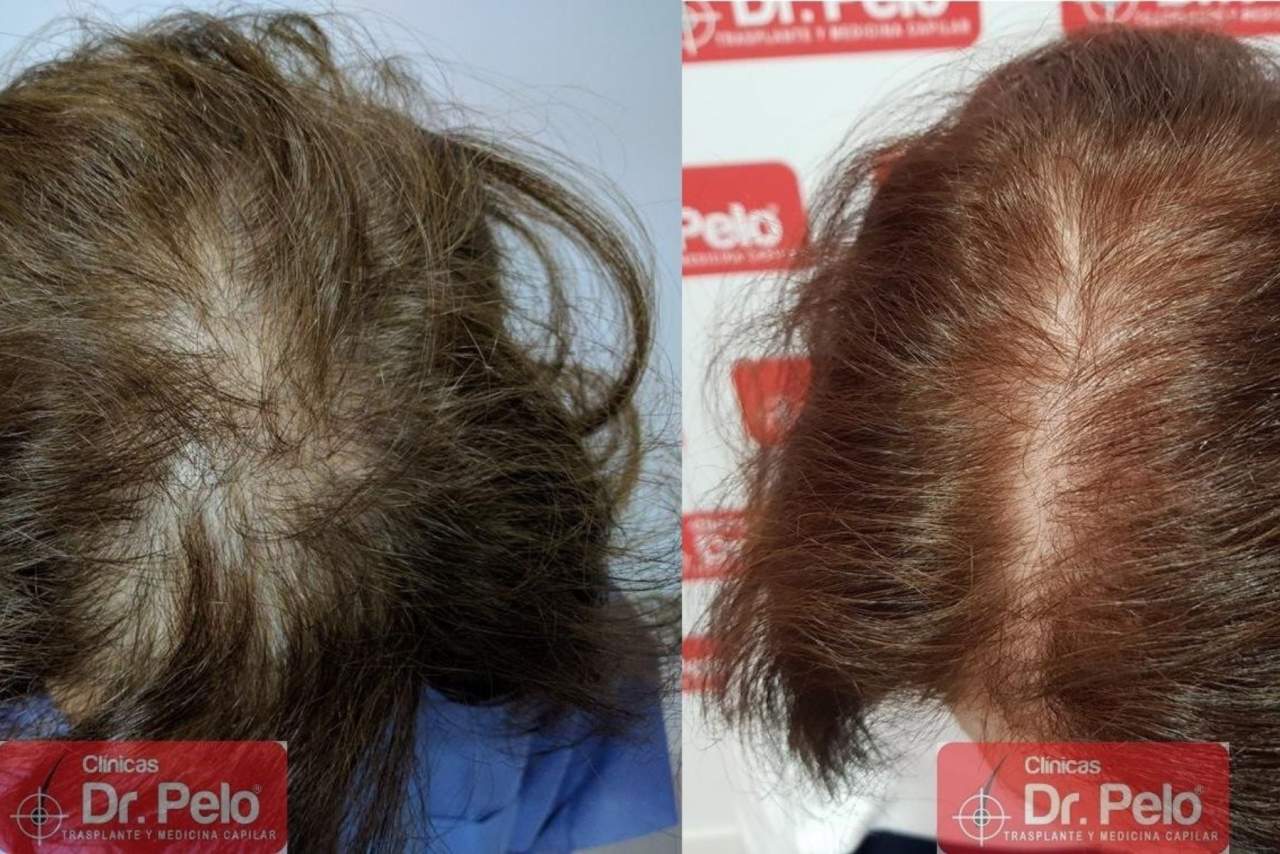 Injerto capilar en Sevilla: la técnica de la Clínica Dr. Pelo
