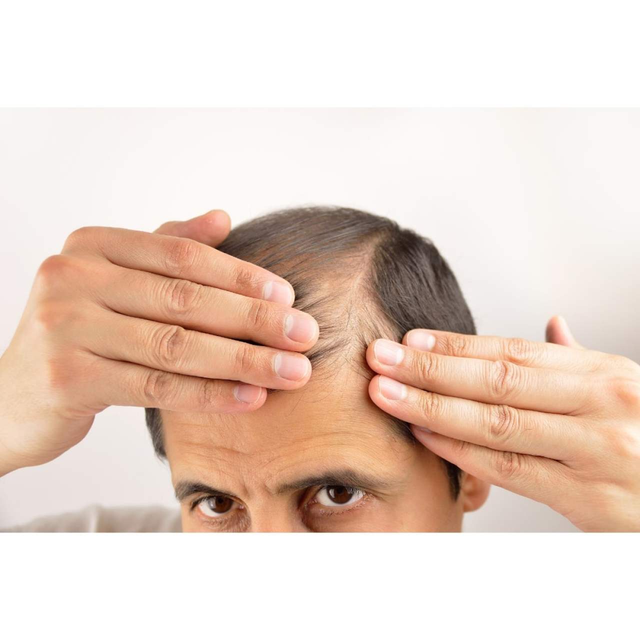Prevenir la caída del cabello en Barcelona gracias a Dr. Carlos Zito