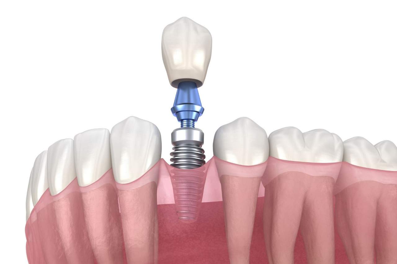 ¿Los implantes duran para siempre?¿Qué cuidados necesitan? Helident Training Center