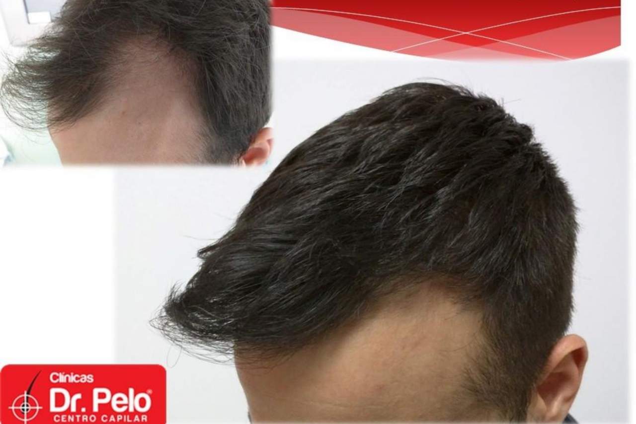 Dr. Pelo: ¿El trasplante capilar es la nueva tendencia en medicina estética?