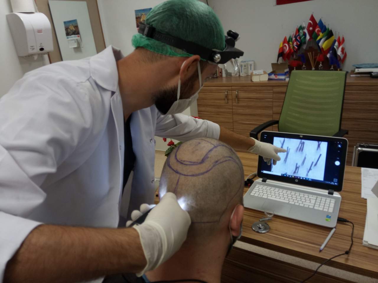 Turismo capilar en Turquía en Fue Hair Transplant System