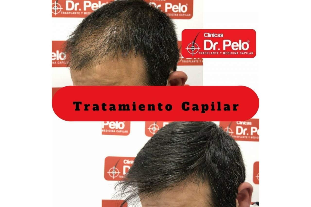 Aumento de popularidad del transplante capilar en los últimos años en España gracias a la mejora de los precios y las técnicas aplicadas