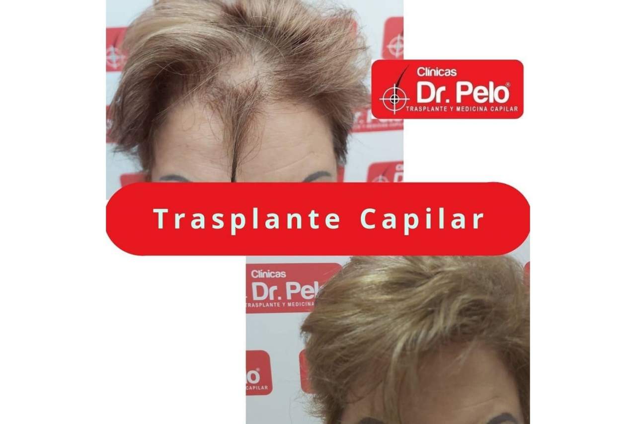 ¿Qué opinan los clientes sobre el injerto capilar de las Clínicas Dr. Pelo en Sevilla?