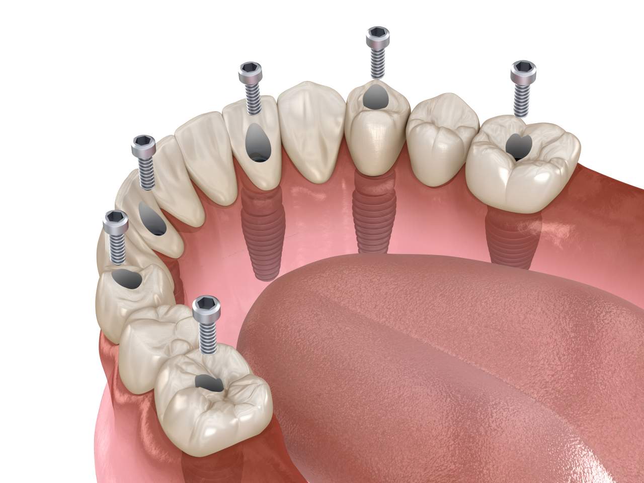 Los dentistas de la Clínica Helident Sevilla recomiendan el uso de la mejor calidad en implantes