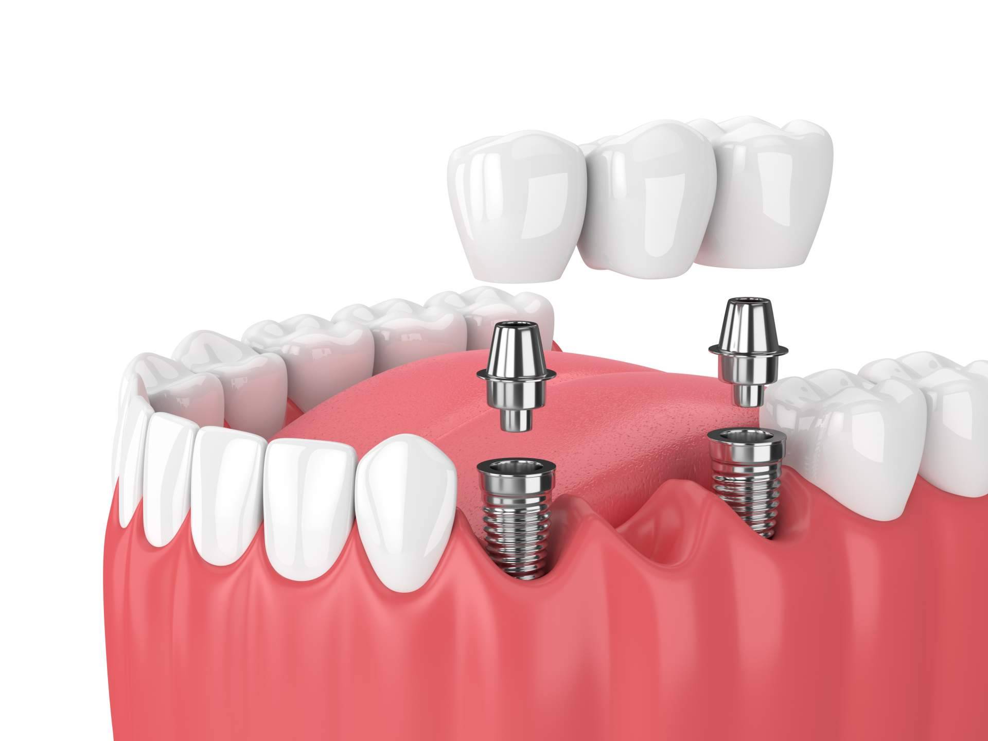 El exclusivo implante dental de titanio en la Clínica de Odontología Artydents de Madrid por solo 199€