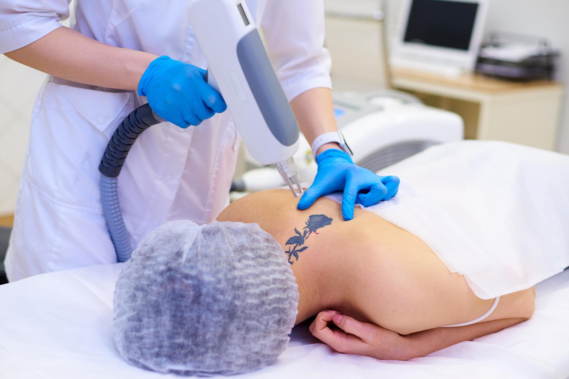 El centro Bodyslim dispone de Yag Láser para eliminar tatuajes
