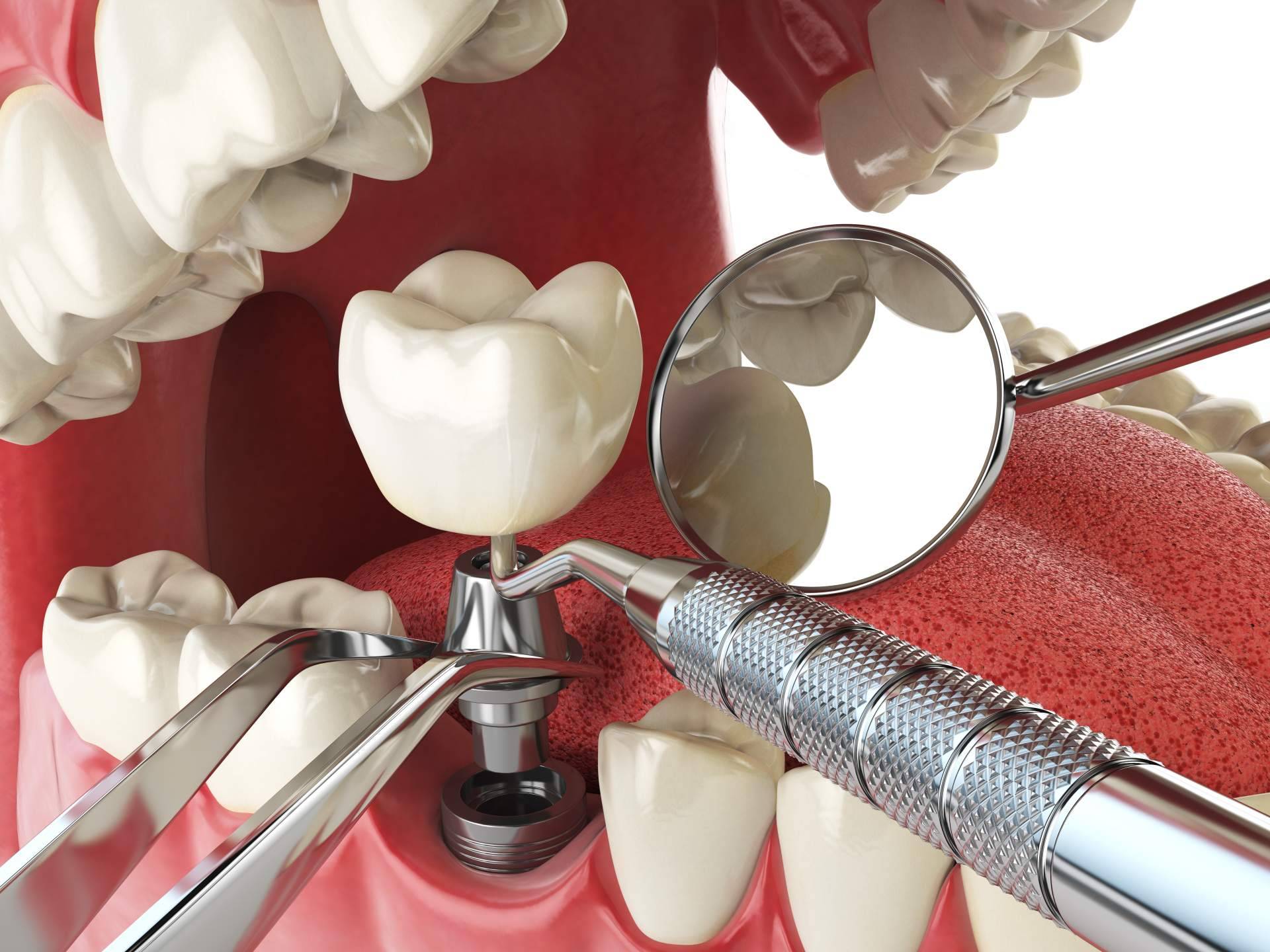 Tener dientes fijos en un solo día es posible gracias a los implantes dentales de titanio V de la Clínica Artydents en Madrid