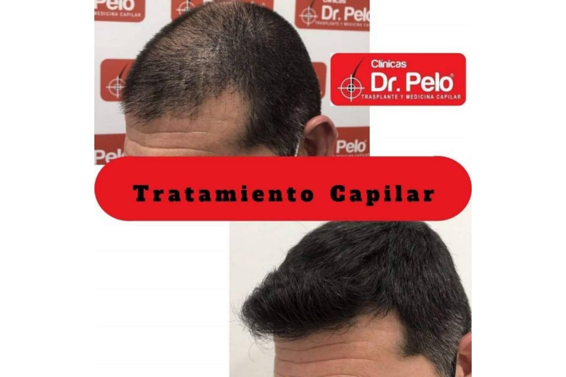 ¿Cómo frenar las entradas en el pelo gracias a las Clínicas Dr. Pelo? La importancia del trasplante capilar cuando se pierde cabello
