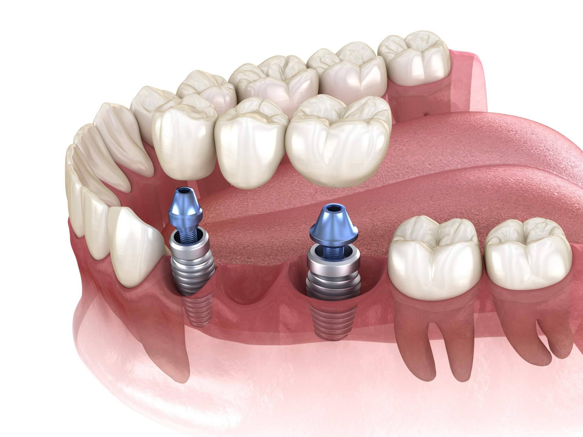 ¿Por qué es tan exitoso el implante dental de titanio V de la Clínica Artydents en Madrid?