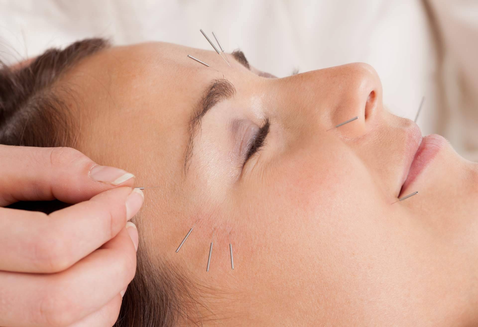 ¿En qué consiste la acupuntura estética a domicilio? Kikai