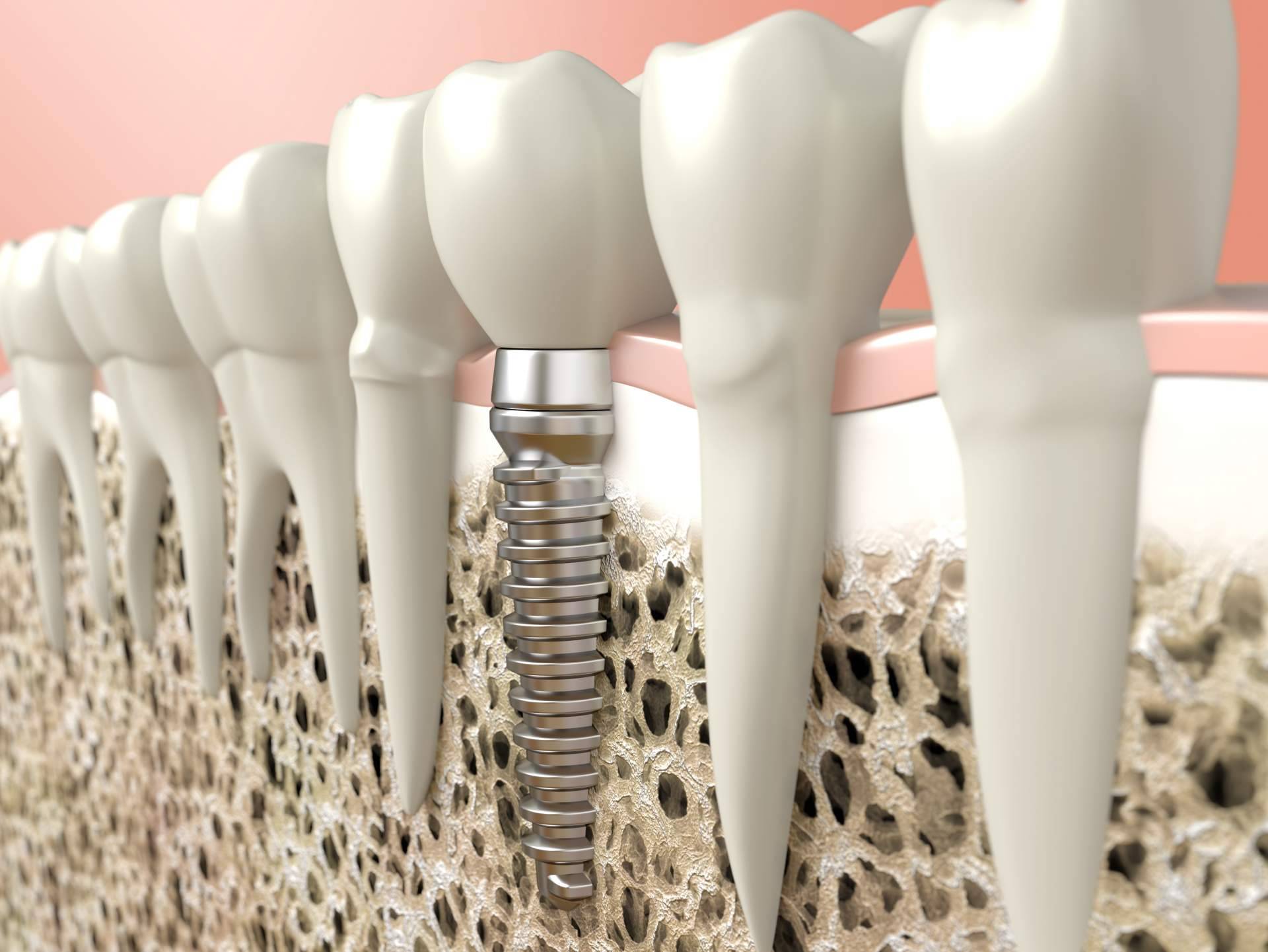 La Clínica Dental Heins, en Valladolid, ofrece servicios de tratamiento de implantes dentales y ortodoncia invisible