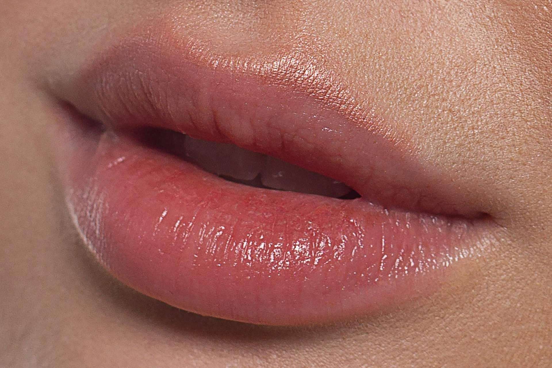 ABB Medicina Estética: aumento de labios