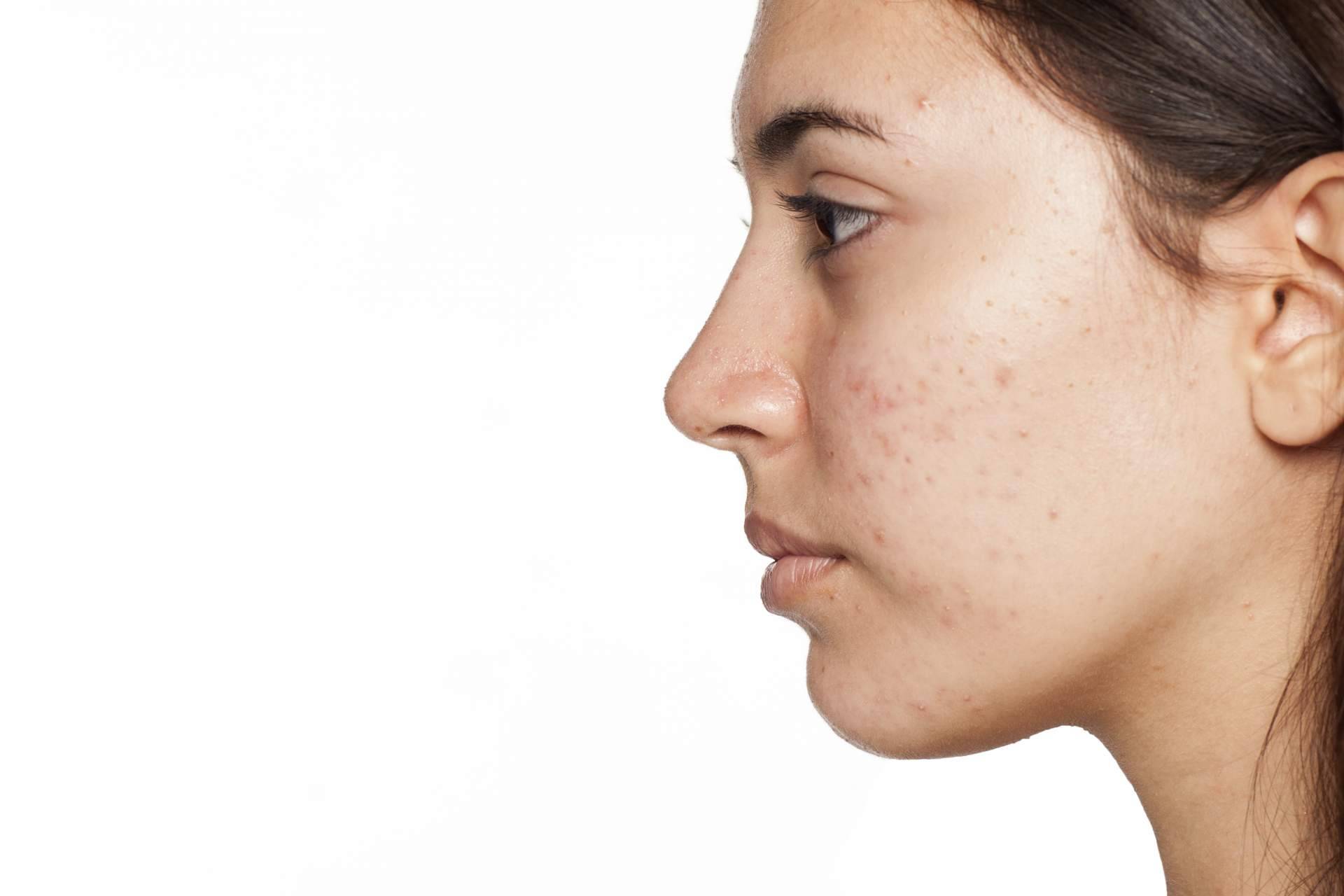 AcnéXero, app de inteligencia artificial fundada por dos dermatólogos, logra terminar con las espinillas y el acné