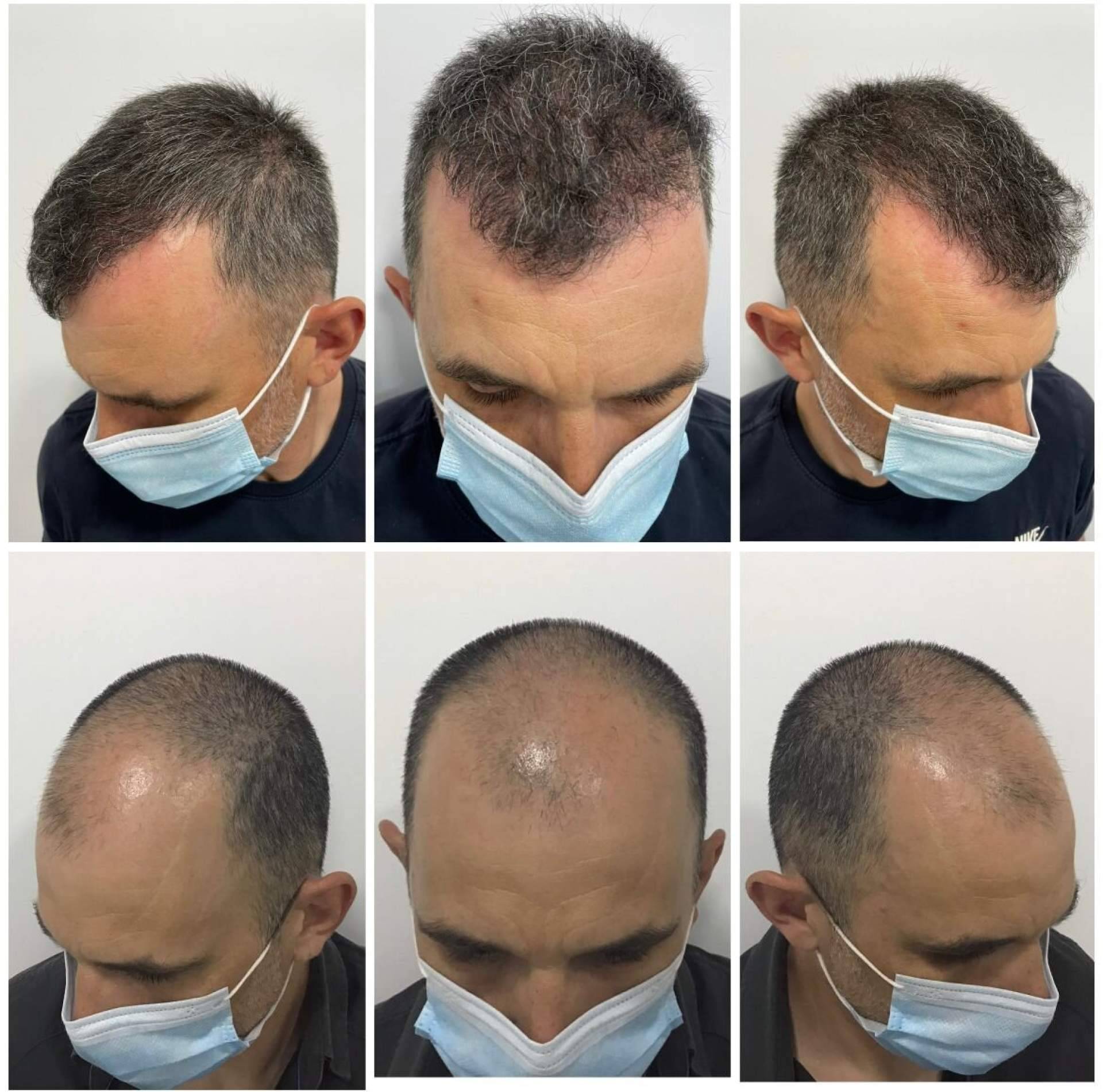 Natural y denso: Así es el injerto capilar ofrecido por el Dr. Bruno Jacobovski en Barcelona