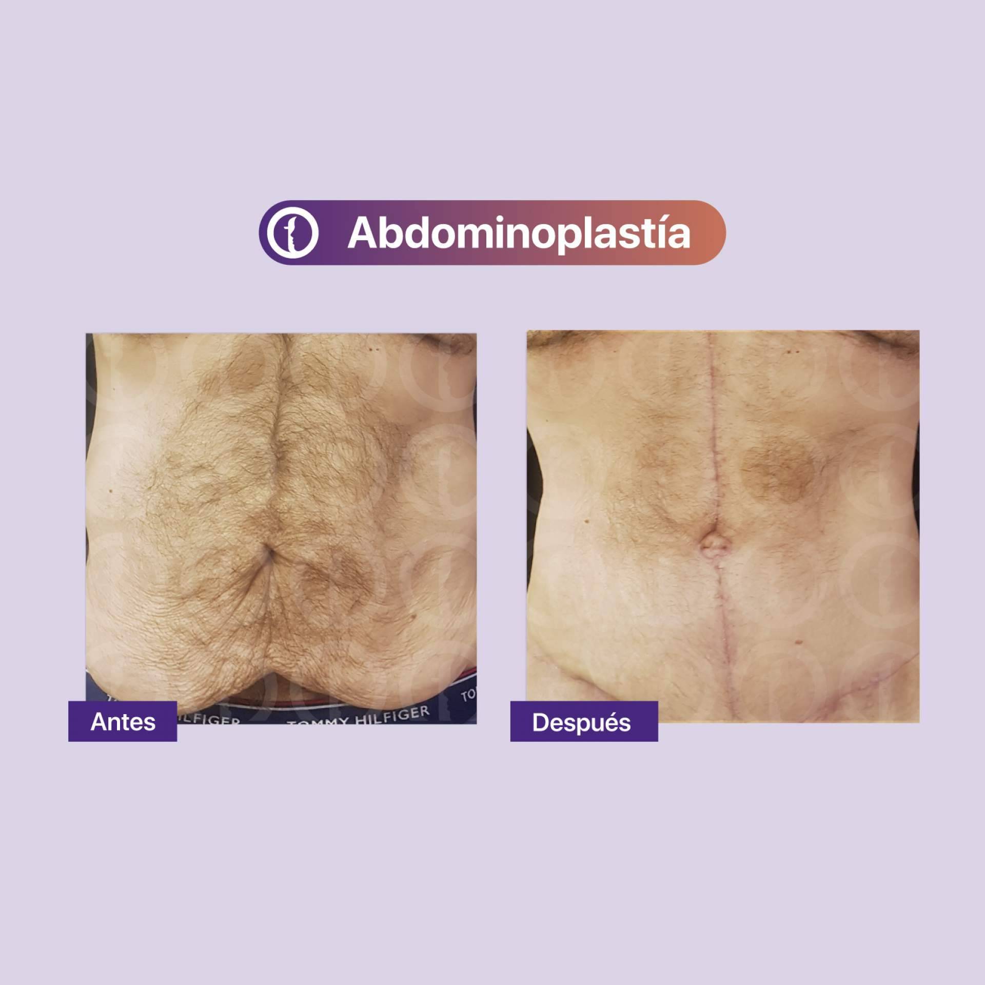 Clínica Tarrazo realiza el procedimiento de la abdominoplastia