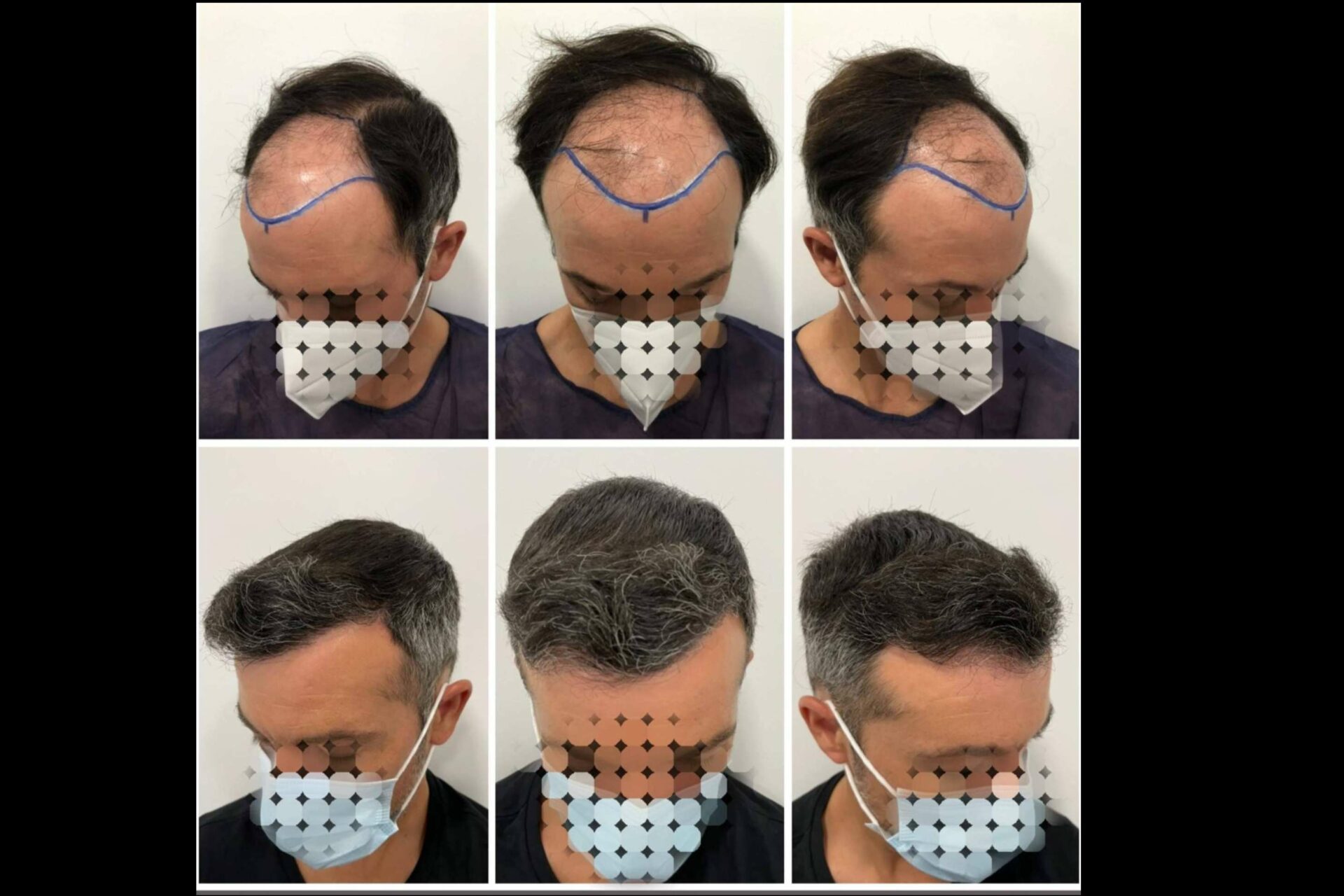 Injerto o trasplante capilar: ¿Cuáles son las técnicas más recomendadas por el especializado Dr Bruno Jacobovski?