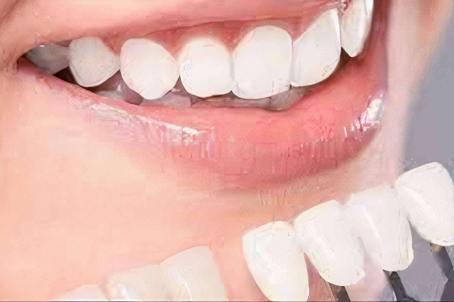 Blanqueamiento dental de calidad para obtener la mejor sonrisa: Implant Clinics