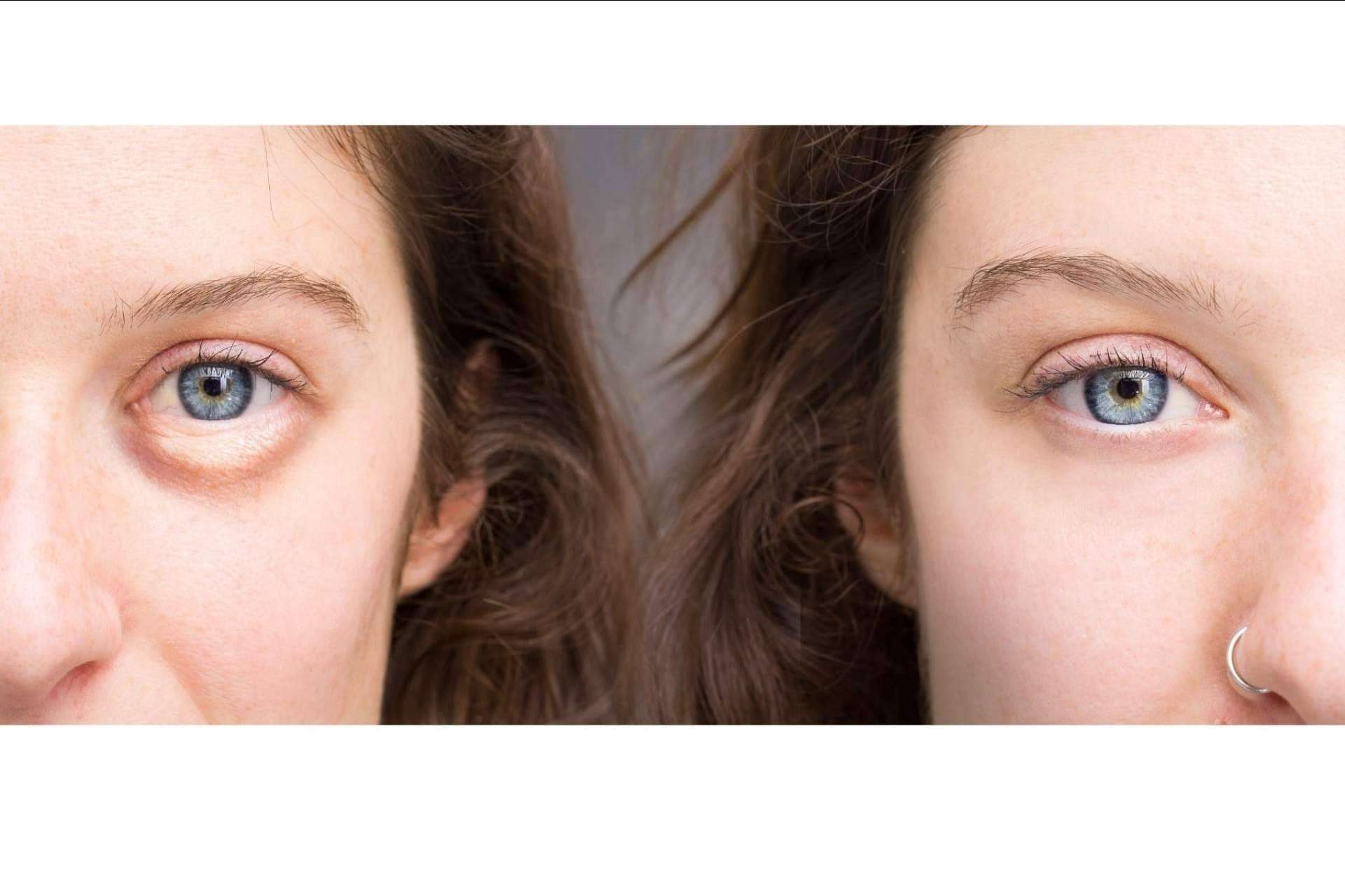 Unidad de medicina estética FEMME de Santiago de Compostela: ácido hialurónico para combatir las ojeras con la Dra. Alfonsina Uriburu