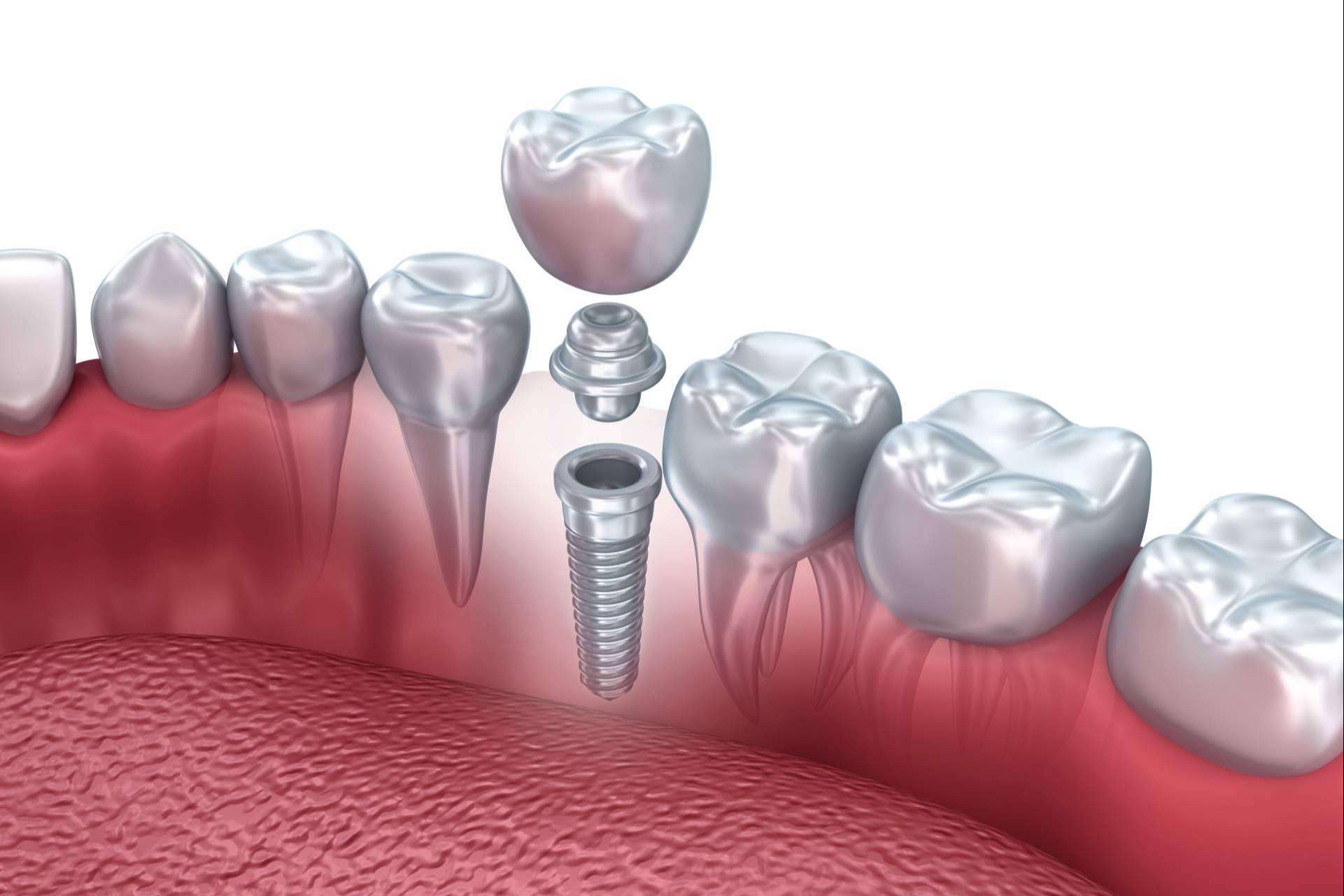 Implante dental en Valladolid: Clínica Dental Heins