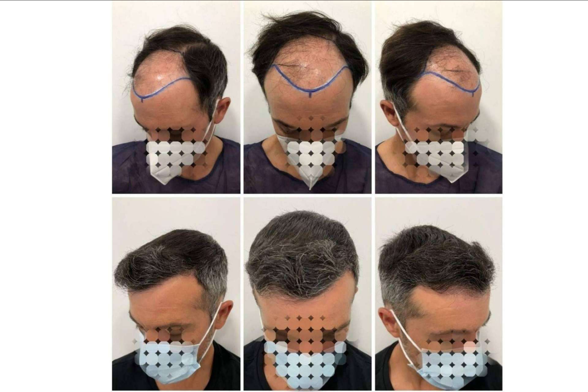 Los beneficios del tratamiento de mesoterapia capilar del Dr. Bruno Jacobovski