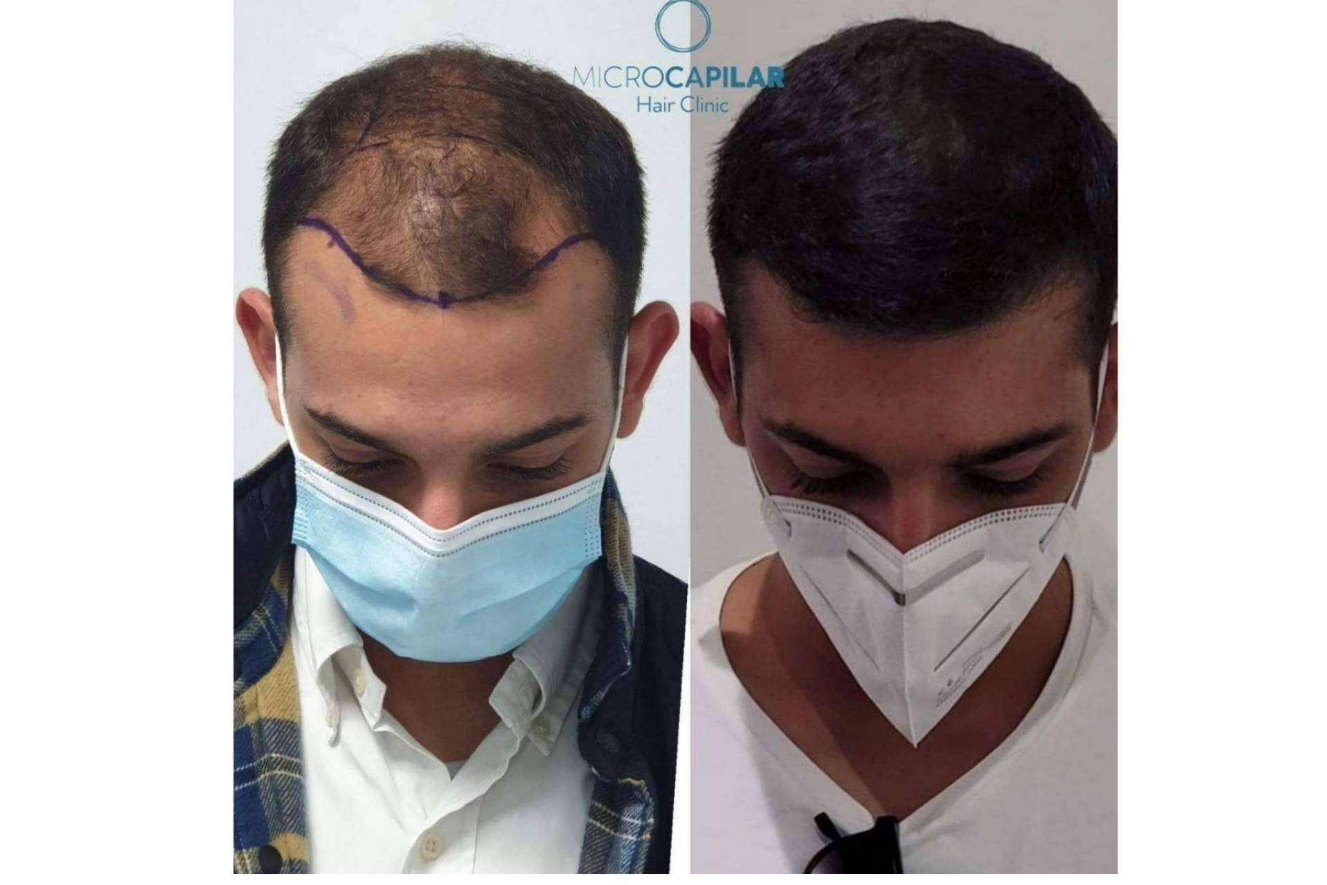 El servicio de Microcapilar Hair Clinic, las ventajas de realizar un injerto capilar en España
