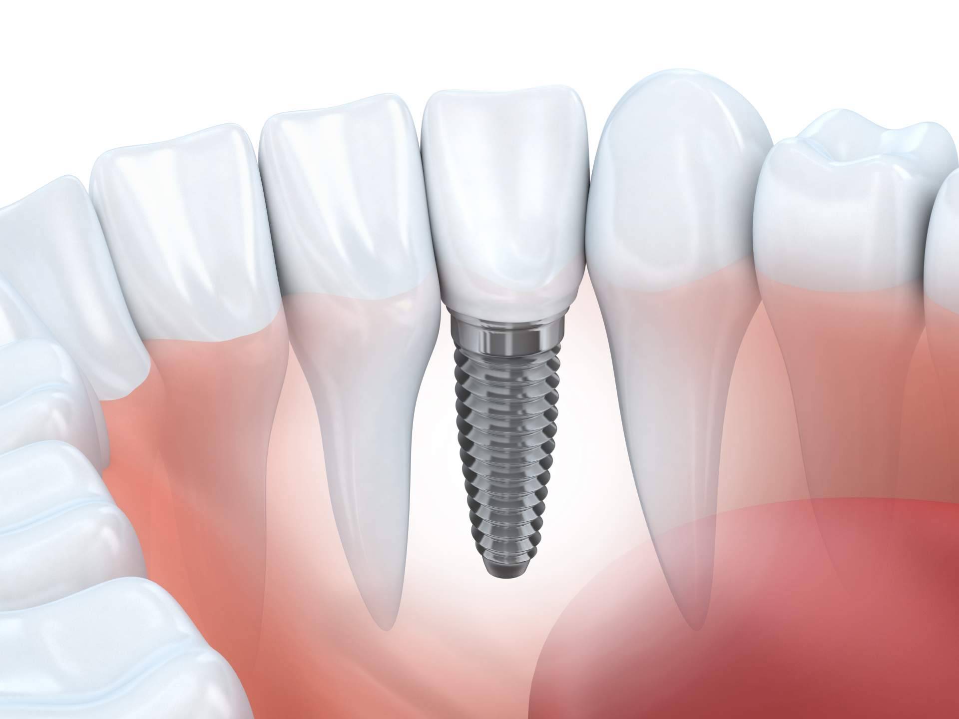 La Clínica Dental Helident realiza el tratamiento de implante dental de titanio en Sevilla
