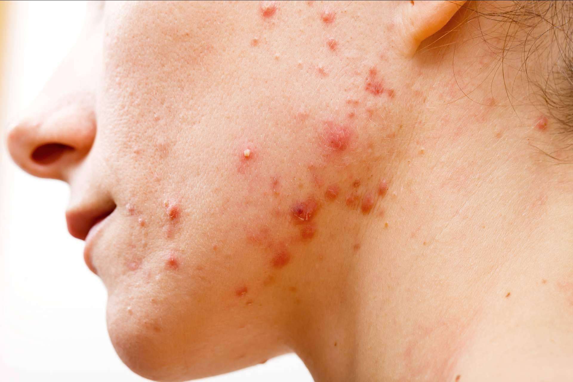 AcnéXero, la aplicación fundada por dermatólogos que propone soluciones efectivas para eliminar el acné