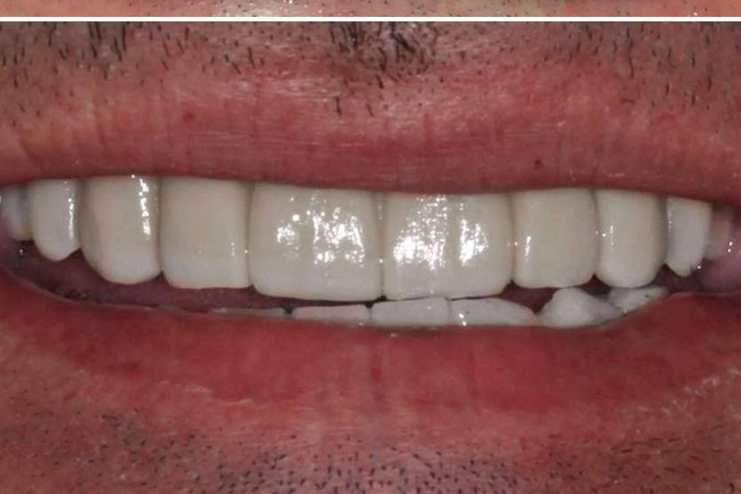 Implant Clinics destaca los beneficios de su tratamiento ALL ON 4