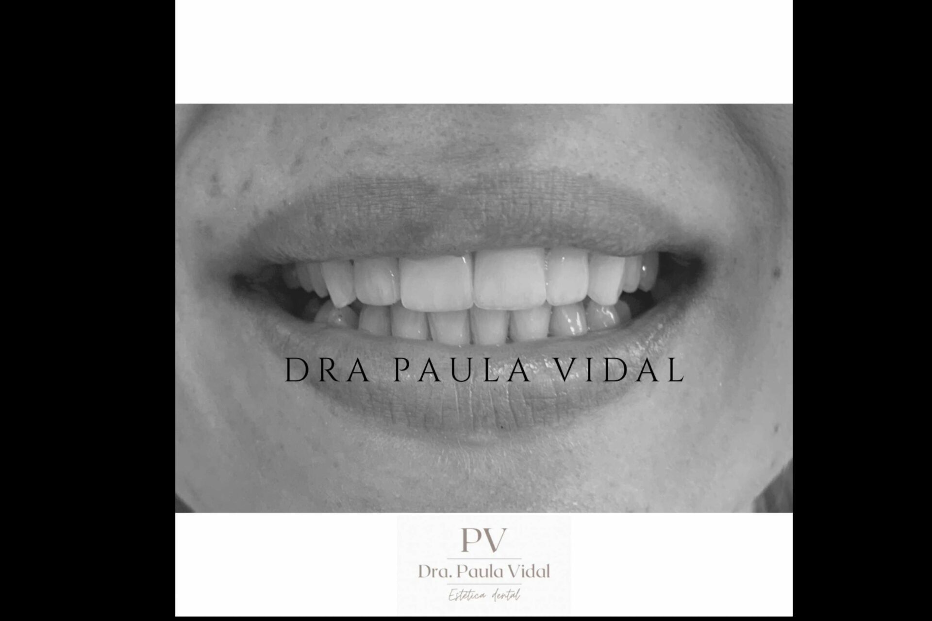 El servicio de carillas dentales en la Clínica Paula Vidal