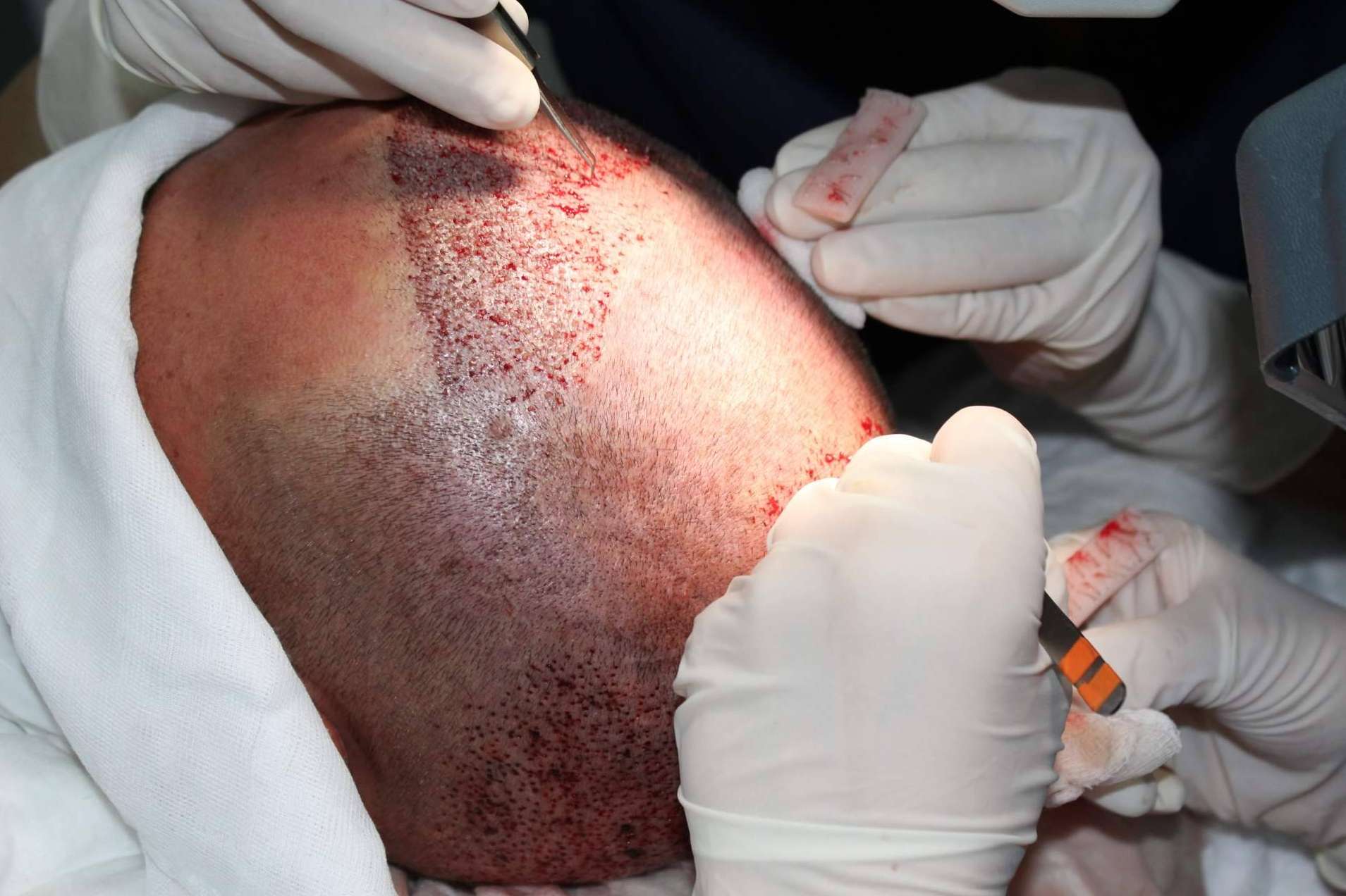 Recuperar el cabello con Injerto Capilar en Murcia y sus técnicas