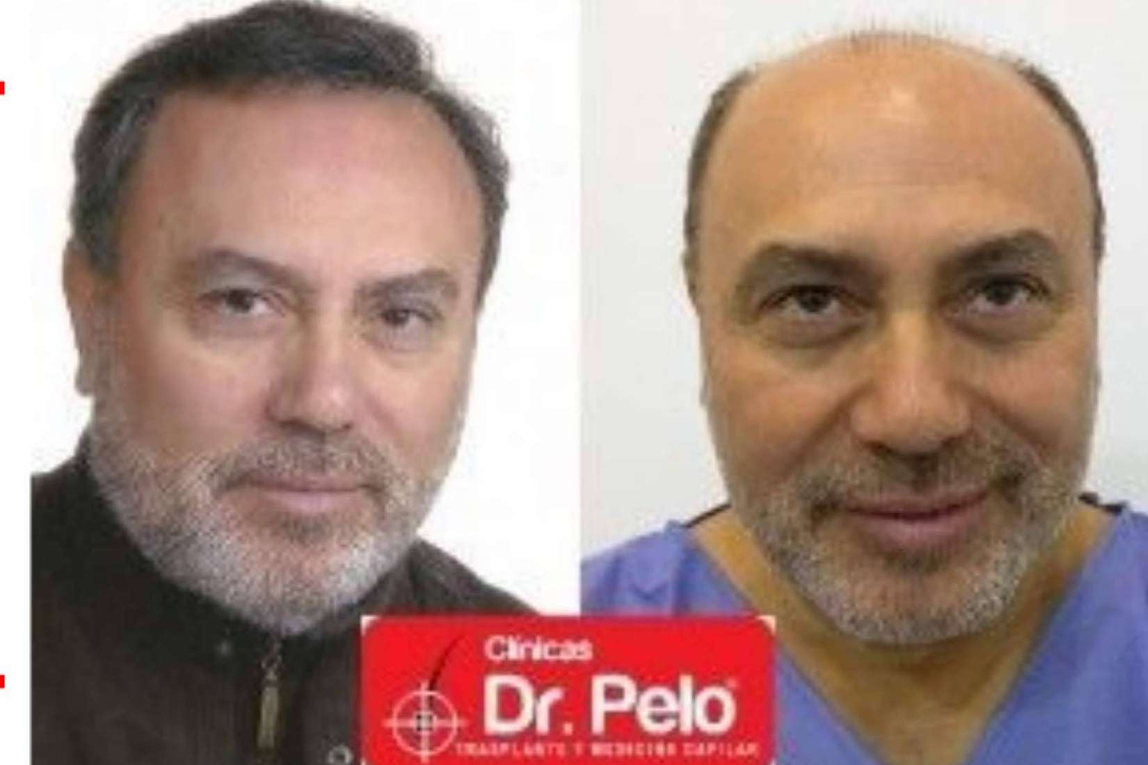 Clínicas Dr. Pelo asegura que es importante la realización de trasplantes capilares con efecto natural