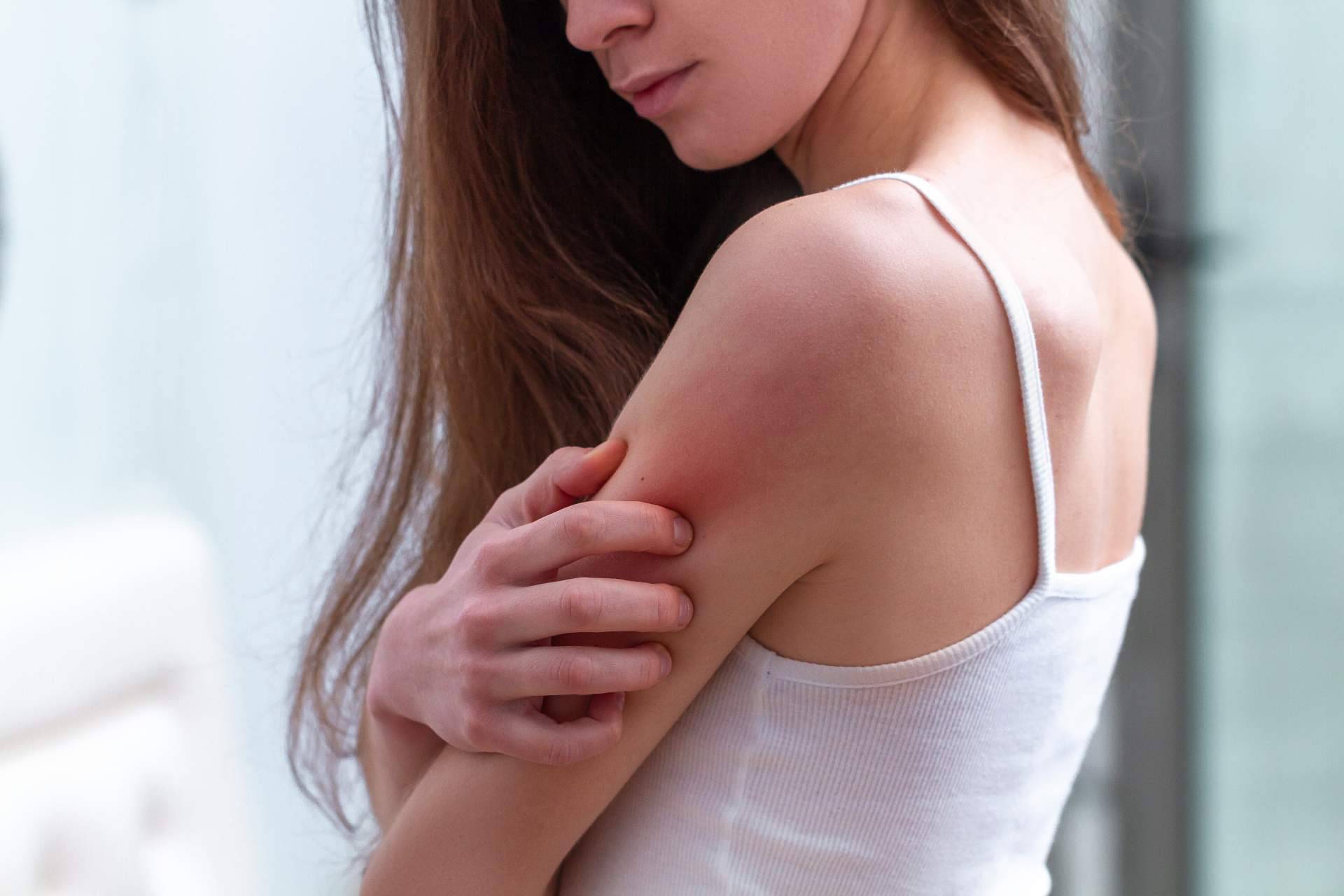 En Laboratorio Géomer, se puede encontrar un tratamiento natural psoriasis corporal sin cortisona