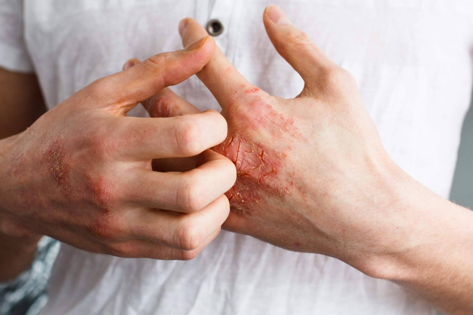 ¿Eczema atópico o eczema de contacto?, por Laboratorio Géomer