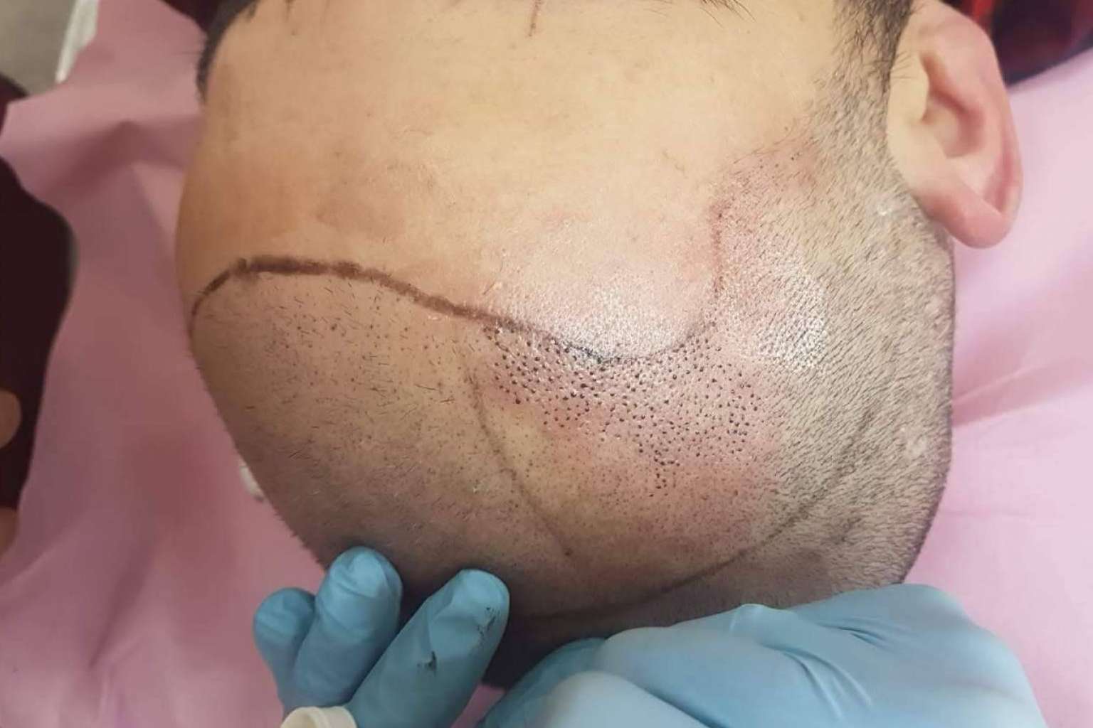 Los profesionales de la micropigmentación pueden ampliar sus conocimientos y aprender técnicas de micropigmentación capilar en el centro VG Virginia Gómez