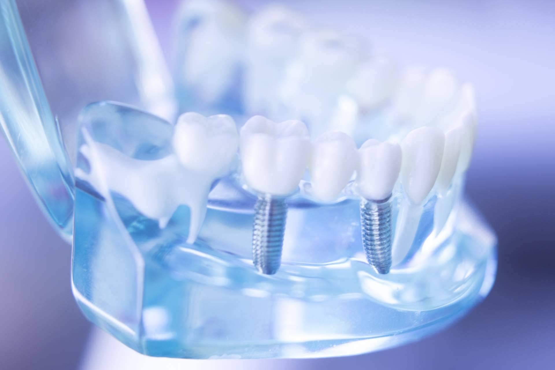Los implantes cigomáticos de la clínica Corrales Dental