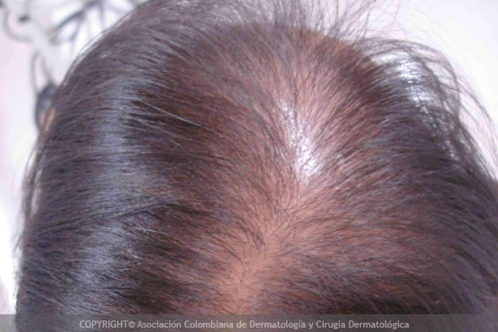Tipos de alopecia femenina y métodos para combatirla según Injermur