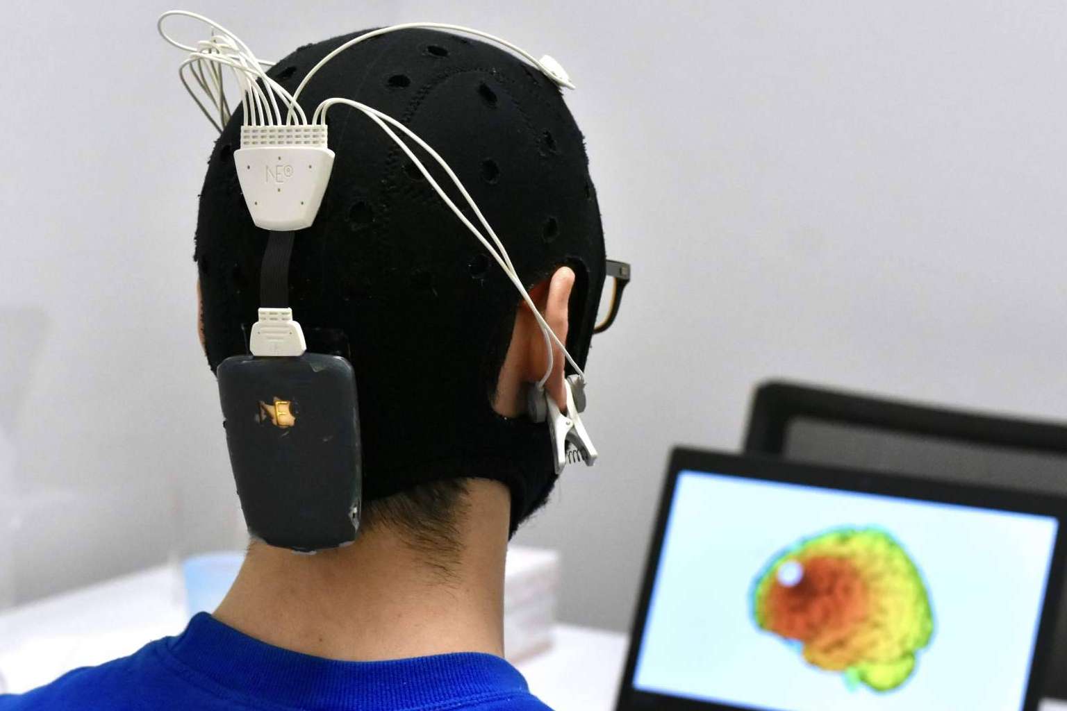 Los tratamientos de neuromodulación ayudan a la recuperación tras sufrir un ictus