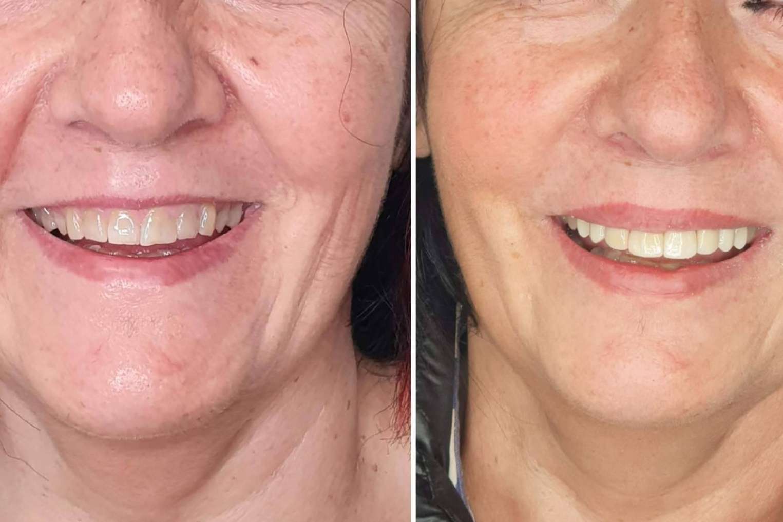 Conseguir una sonrisa Hollywood de la mano de Dentinova