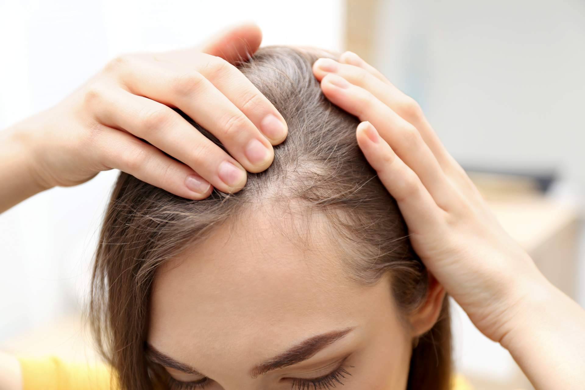 Élite Capilar ayuda a tratar la alopecia con injertos capilares efectivos