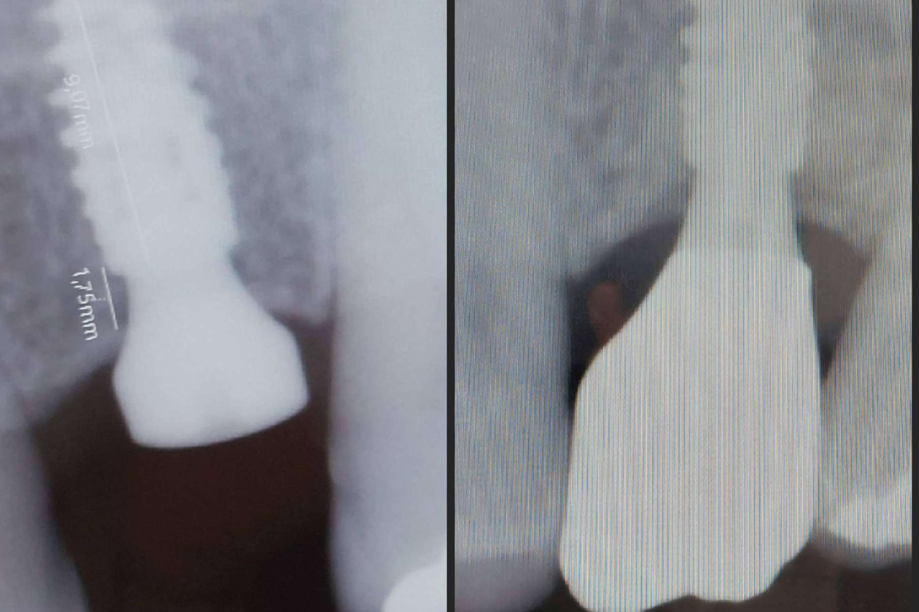 Dentinova realiza implantes dentales en un día con su tecnología digital