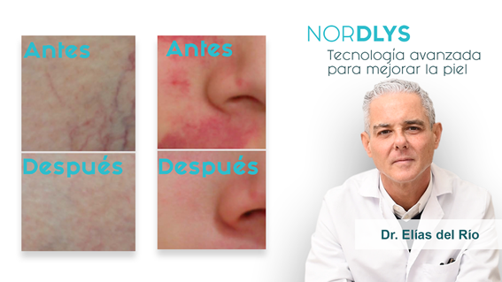 Aterriza en Donostia el primer Nordlys con IPL y láser para rejuvenecer y tratar afecciones sin cirugía