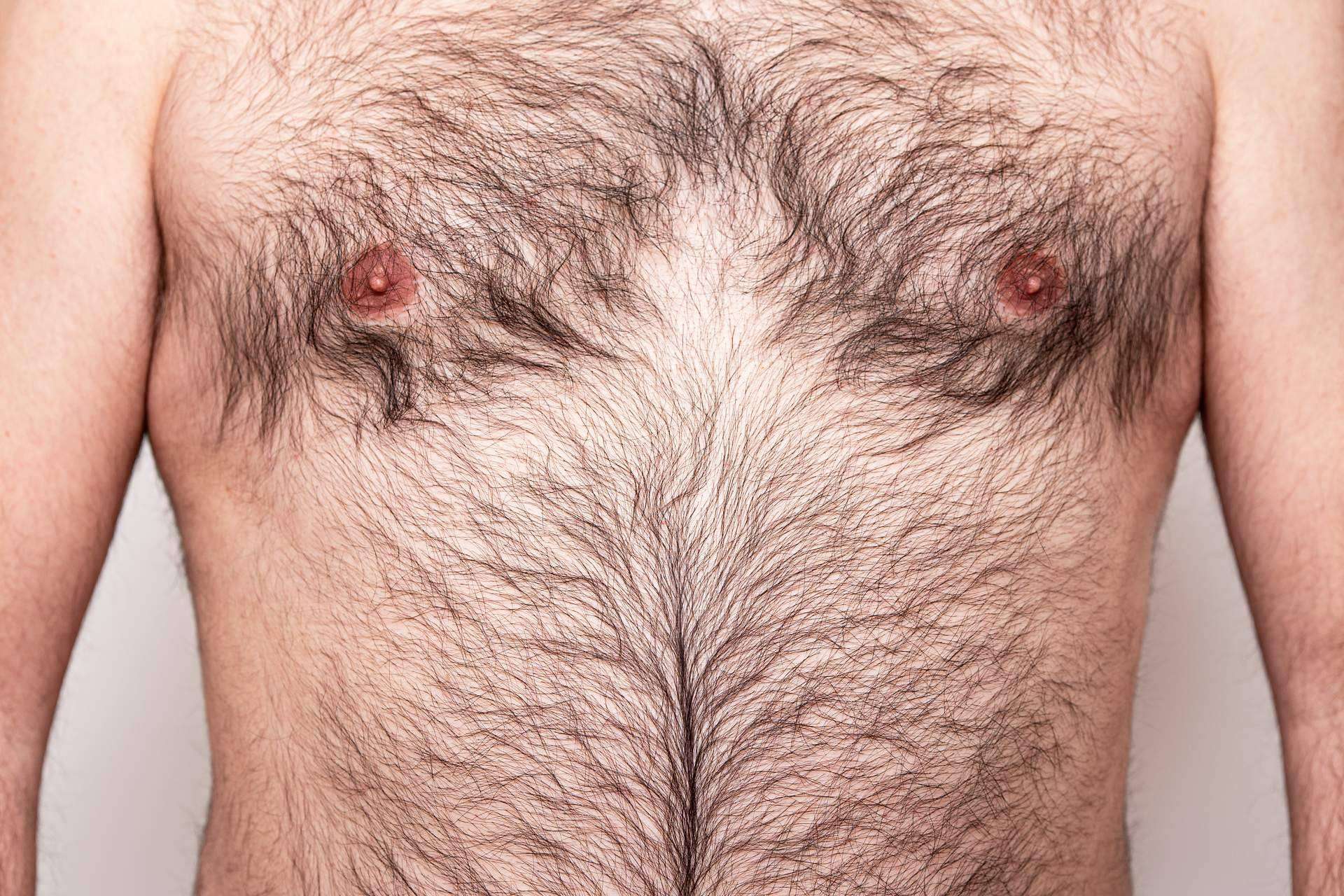 La técnica Body Hair es óptima para casos de alopecia avanzada