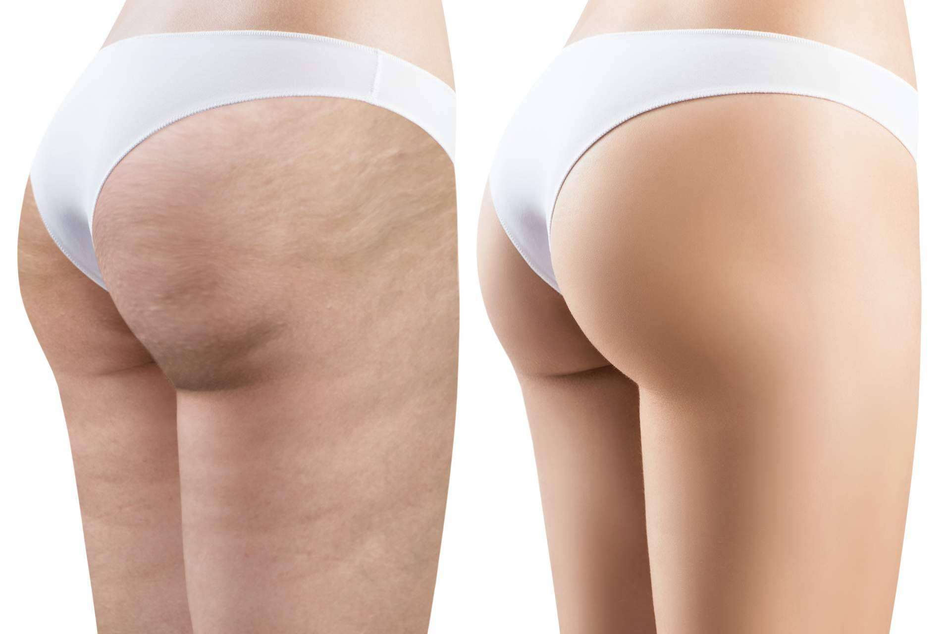 Crina Rus Beauty Center realiza tratamientos con envolturas de algas reductoras para combatir la celulitis