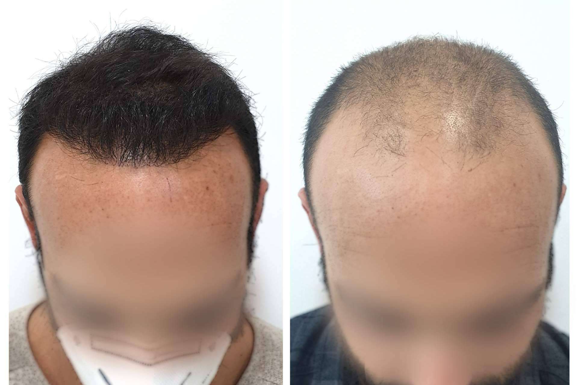 Combatir la alopecia androgénica de la mano de Injermur